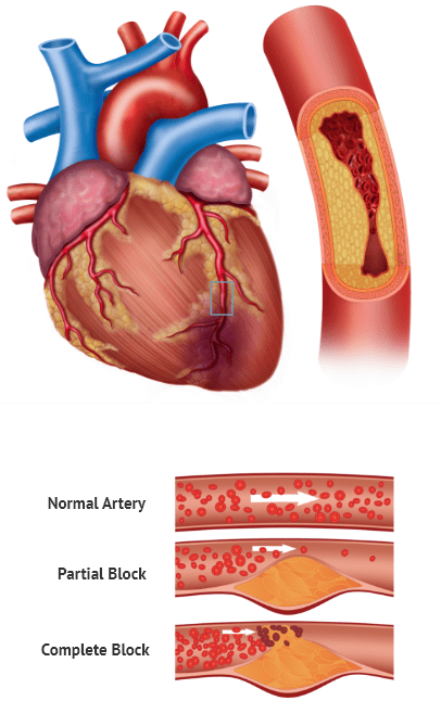 myocardial-infarction-symptoms-causes-precautions-risk-factors